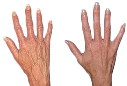 Effect of Neoveris for the treatment of varicose veins of the hands