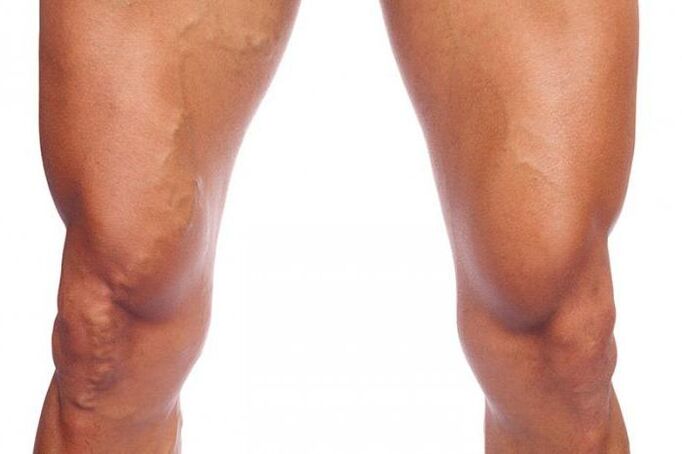 Different veins