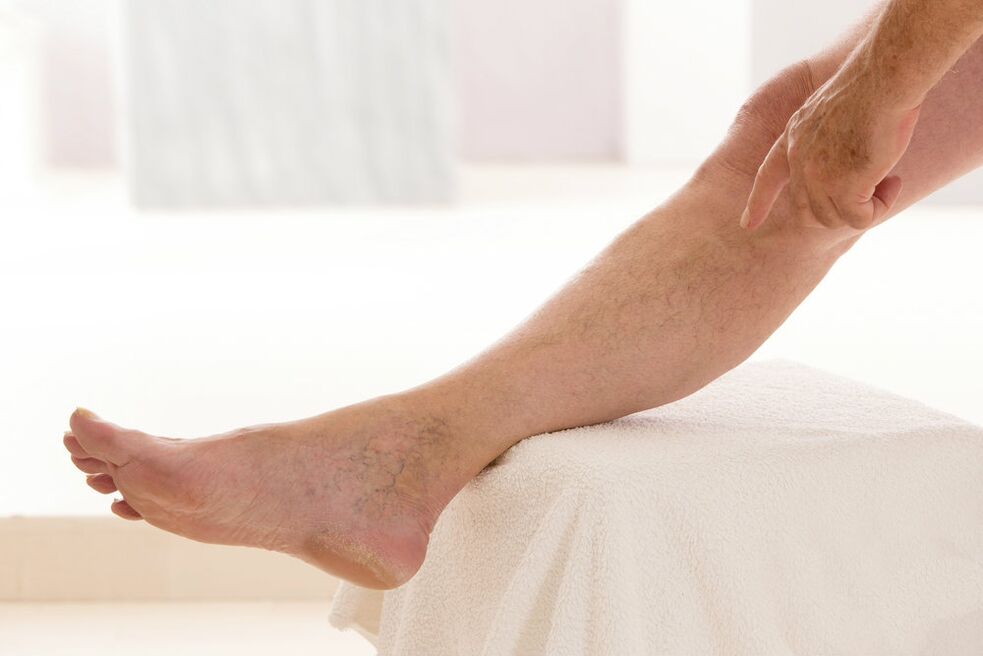 varicose veins